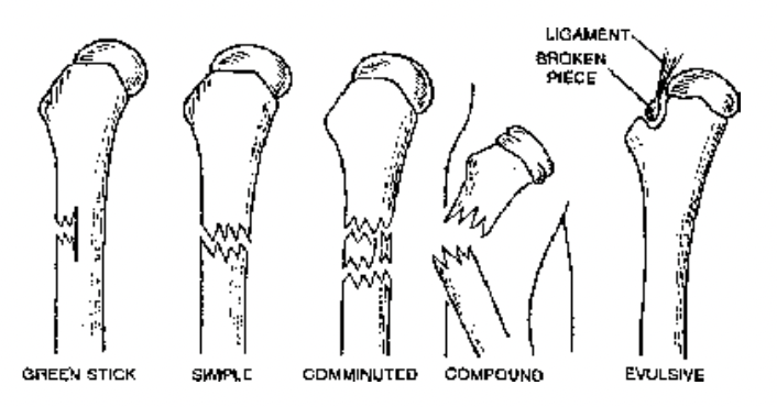 Disorder of Skeletal System